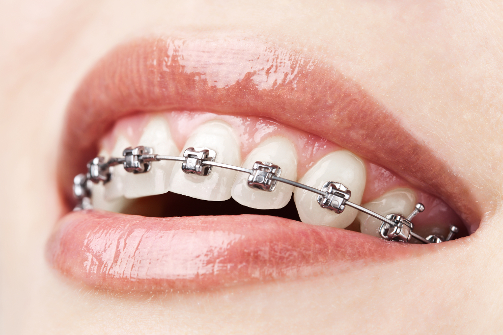 Fixed Lingual with metal braces